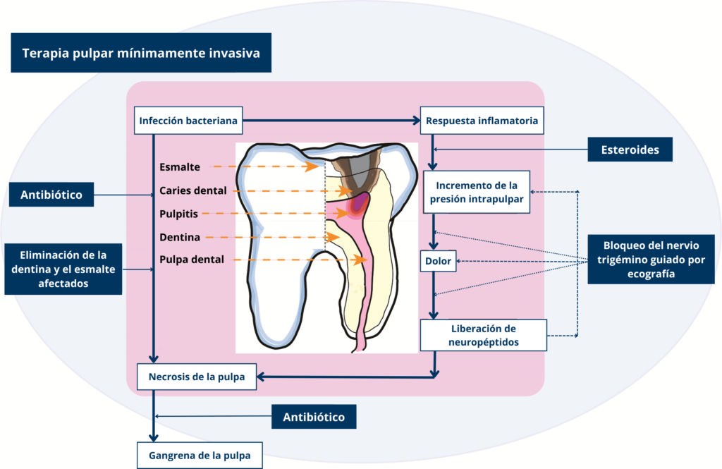 Terapia pulpar mínimamente invasiva infografía terapia pulpar