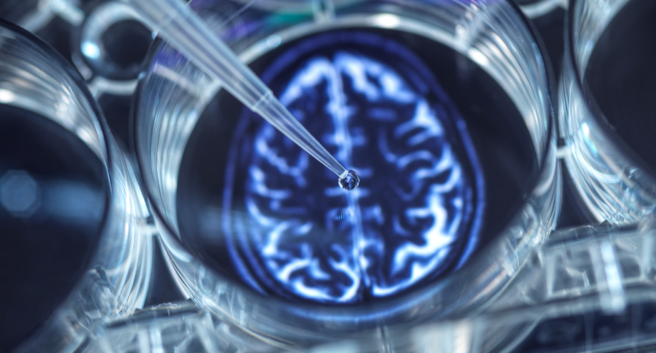 periodontitis y el alzhéimer